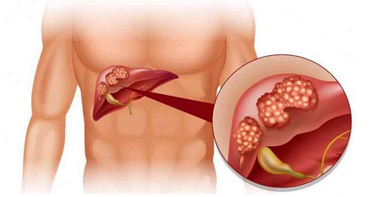 Онкологические заболевания