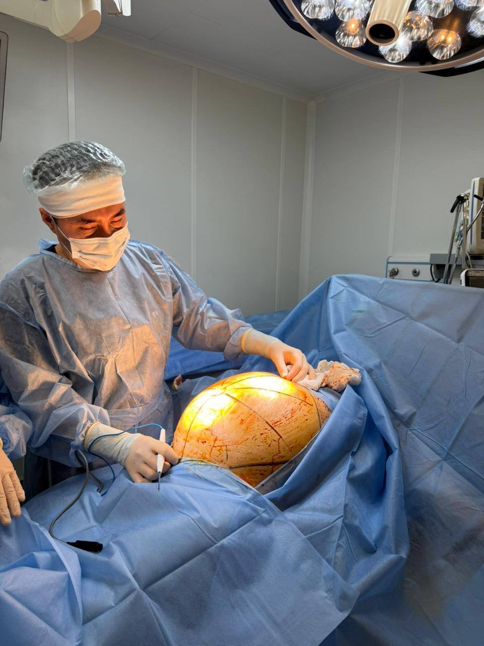 В АЛМАТЫ ПАЦИЕНТКЕ УДАЛИЛИ ГИГАНТСКУЮ 25-КИЛОГРАММОВУЮ ОПУХОЛЬ