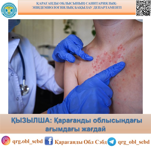 ҚЫЗЫЛША: Қарағанды облысындағы ағымдағы эпидемиологиялық жағдай