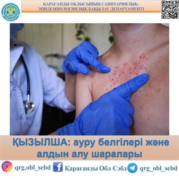 ҚЫЗЫЛША: ауру белгілері және алдын-алу шаралары